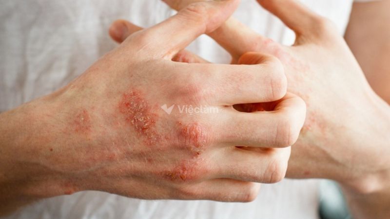 Tác hại của nghề làm tóc? Liệu có đáng để bạn theo đuổi Da bị kích ứng do tiếp xúc với hóa chất